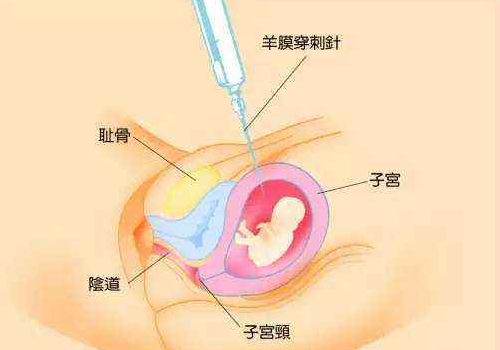 羊水穿刺能查出脑瘫吗 能查出先天性心脏病吗
